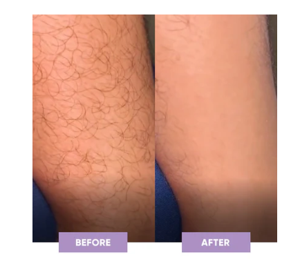 Nano Cristal Hair Removal